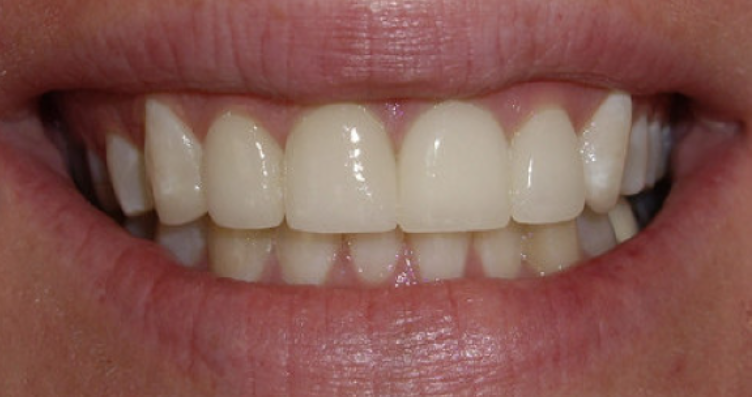 Close-up smile after crowns and bonding treatment