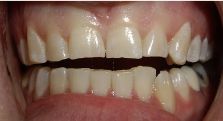 Close-up smile before crowns and bonding treatment