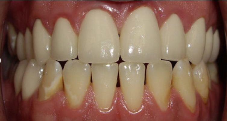 Full mouth rehabilitation after treatment