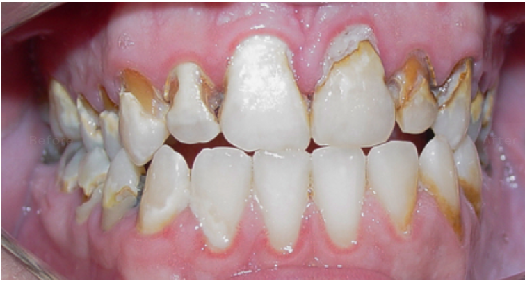 Full mouth rehabilitation before treatment